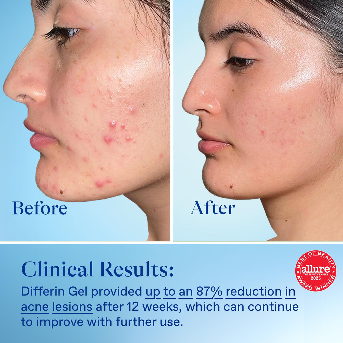 Differin Acne Retinoid Treatment Gel, 0.1% Adapalene, 15g Tube