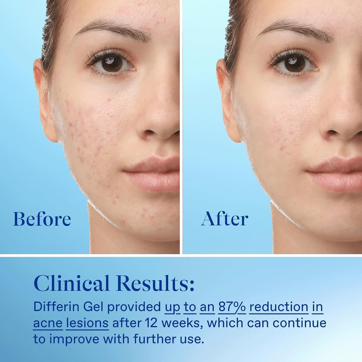Differin Acne Retinoid Treatment Gel, 0.1% Adapalene, 15g Tube