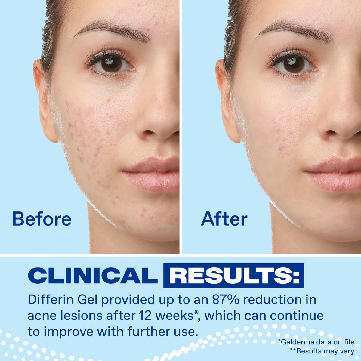 Differin Acne Retinoid Treatment Gel, 0.1% Adapalene, 15g Tube