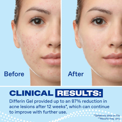 Differin Acne Retinoid Treatment Gel, 0.1% Adapalene, 15g Tube